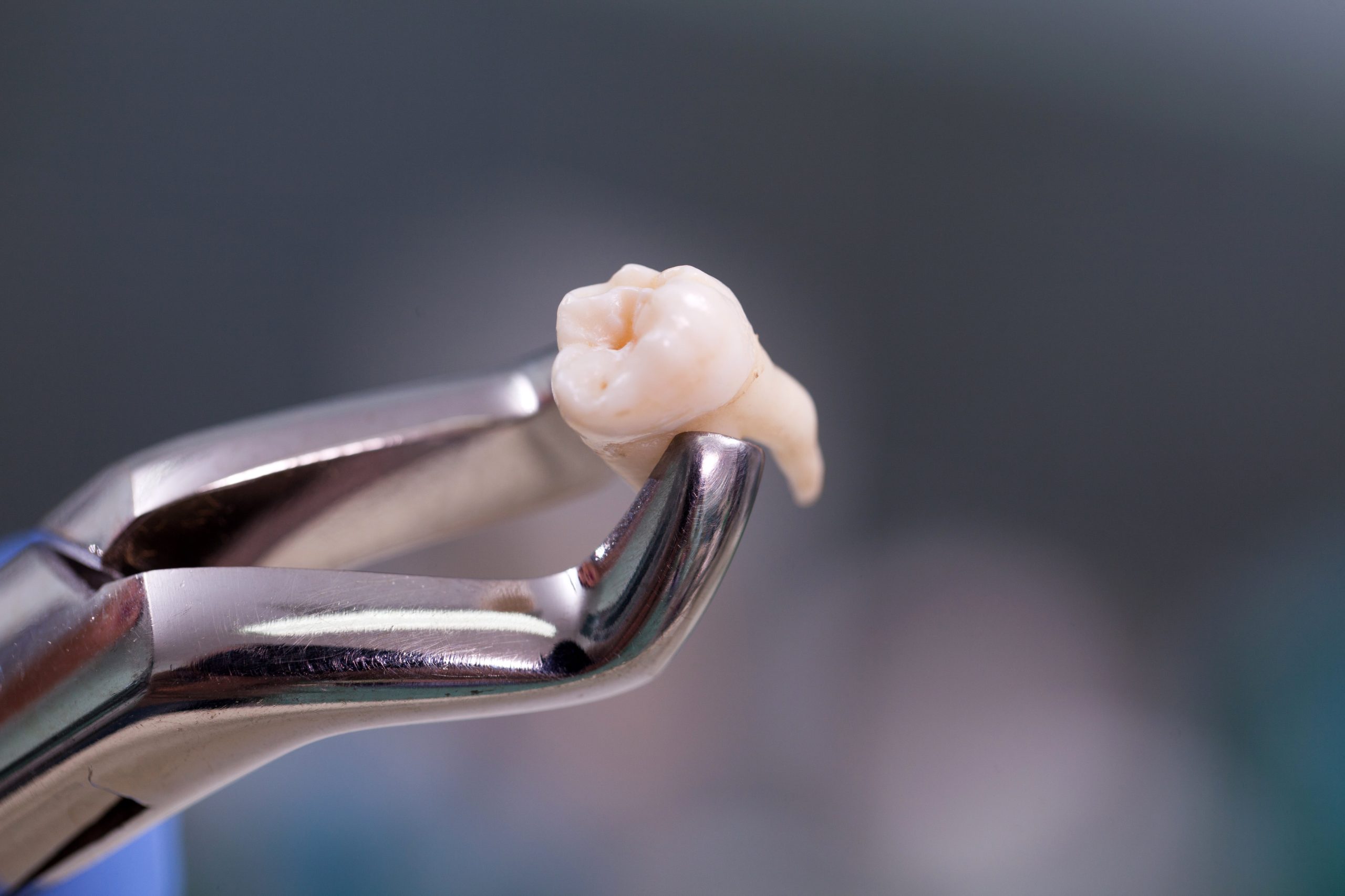 Am I Too Old to Have My Wisdom Teeth Extracted?