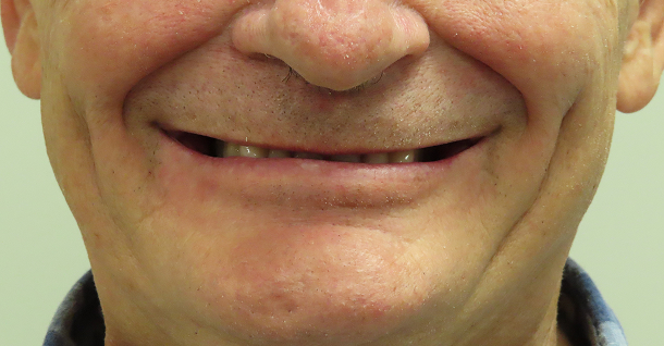 Ben ortho and crowns - Before