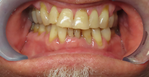 Cam Finals - all on x - Before