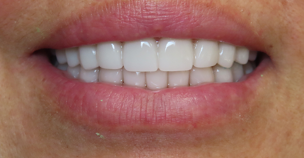 Gina veneers - After