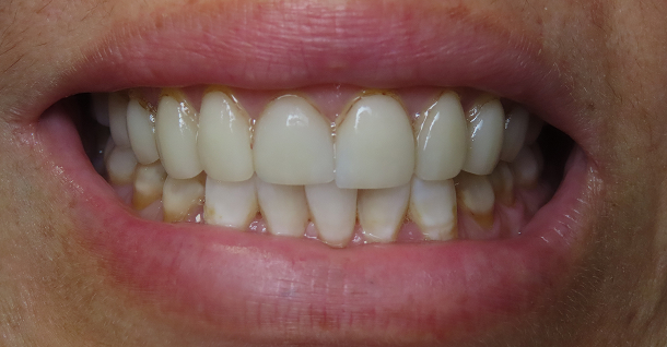 Gina veneers - Before