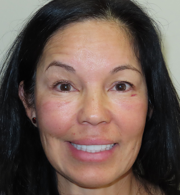 Gina veneers