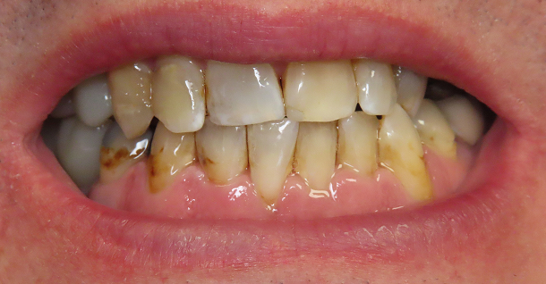 Jonathan full mouth rehab - Before