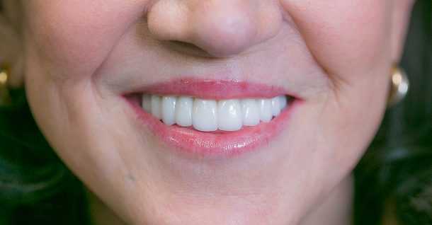 Kathleen veneers - After