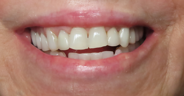 Kathleen veneers - Before