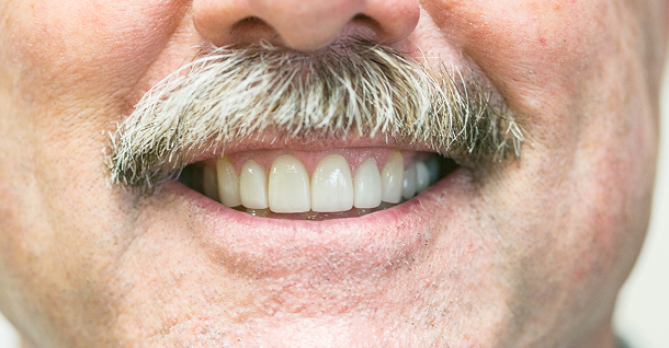 MB Complete Veneers - After
