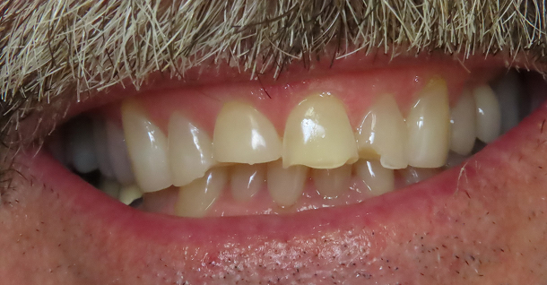 MB Complete Veneers - Before