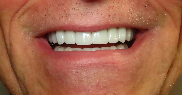 Michael full mouth rehab - After