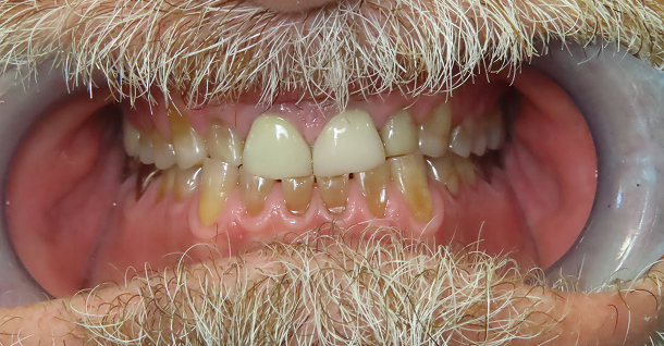Michael full mouth rehab - Before