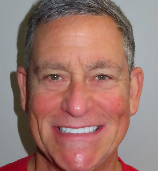 Michael full mouth rehab