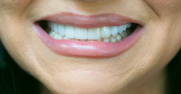 Monica veneers - After