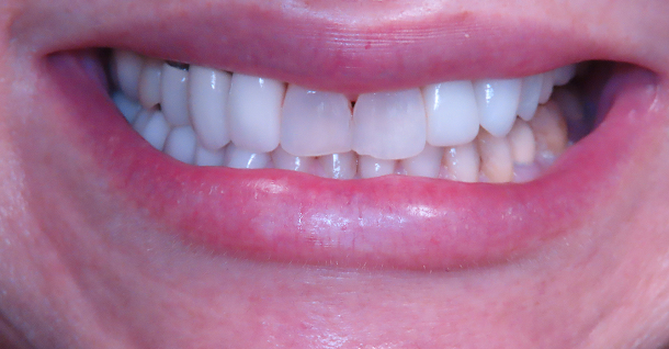Monica veneers - Before