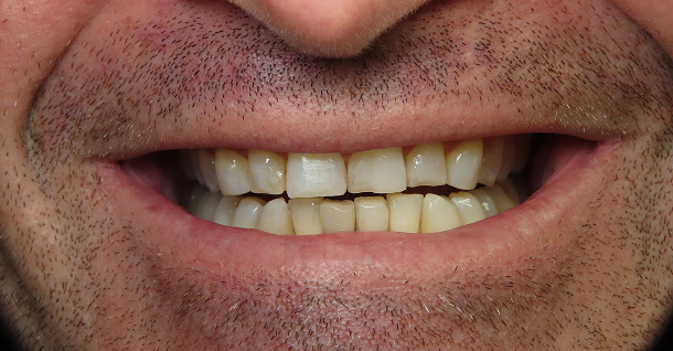 Nathan ortho and veneers - Before