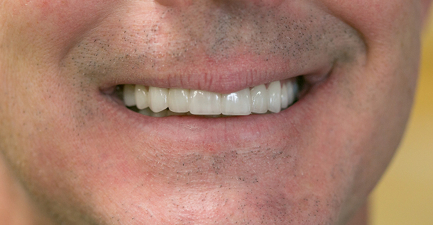 Patrick full mouth rehab - After