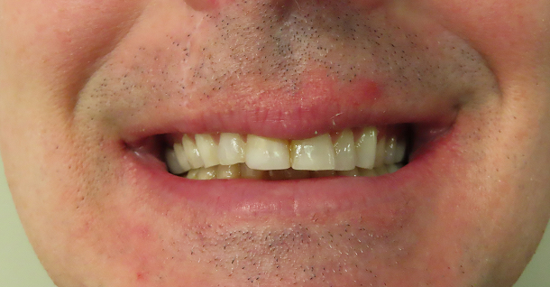 Patrick full mouth rehab - Before