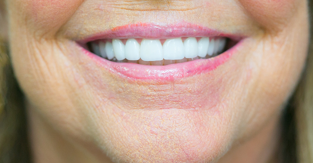 Sandy full mouth rehab - After
