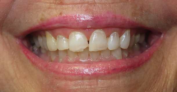 Sandy full mouth rehab - Before