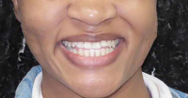 Sarah ortho - Before