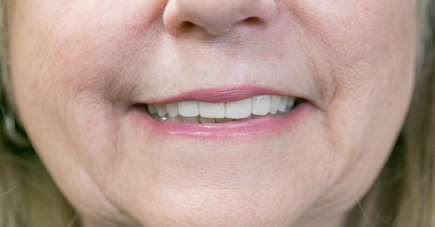 Sherrie ortho and crowns - After