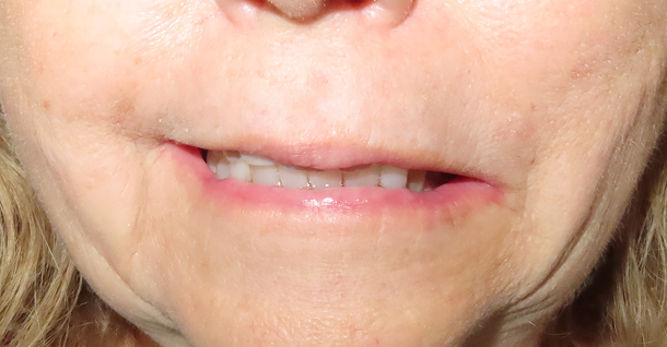 Sherrie ortho and crowns - Before