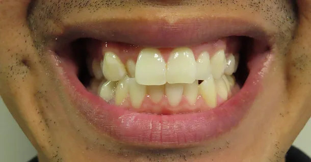 Pedro Non-Surgical Facial Before