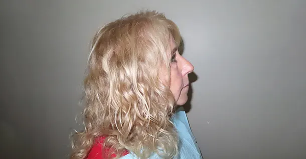 Sherrie Non Facial Patient