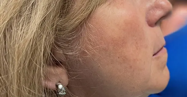 Sherrie Non Facial Patient