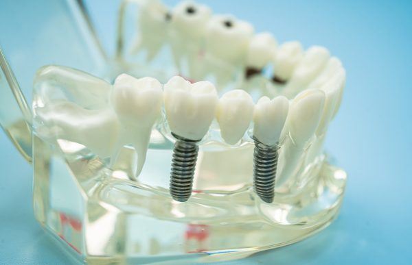Dental implants placed to restore missing teeth