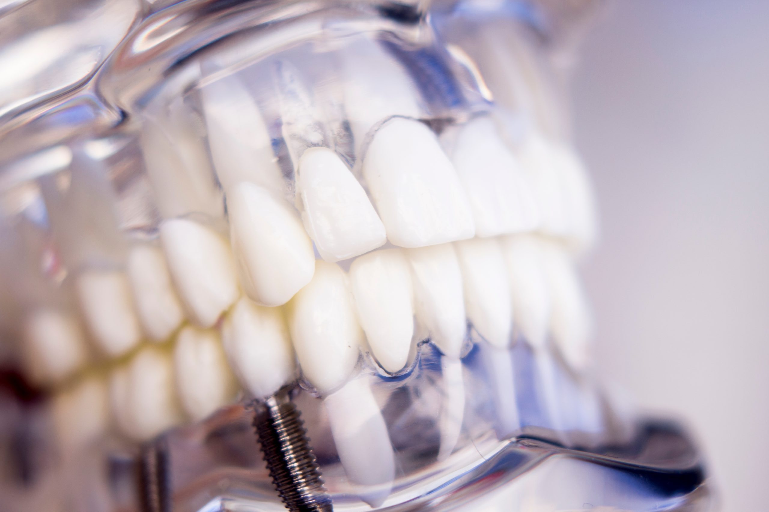 Advancements Dental Implant Technology