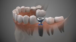 Can Dental Implants Be Removed?