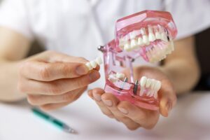 Expert Dental Bridge Care: Discover Top Providers in Downtown San Diego