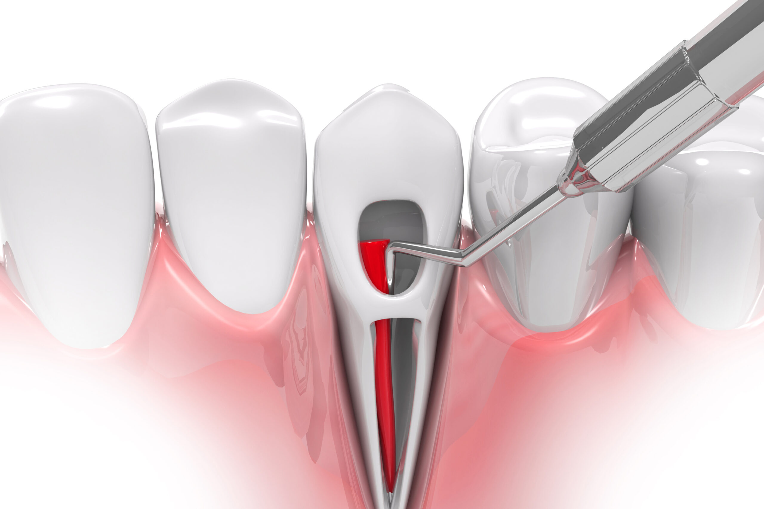 Should I Trust My Dentist to Do a Root Canal?