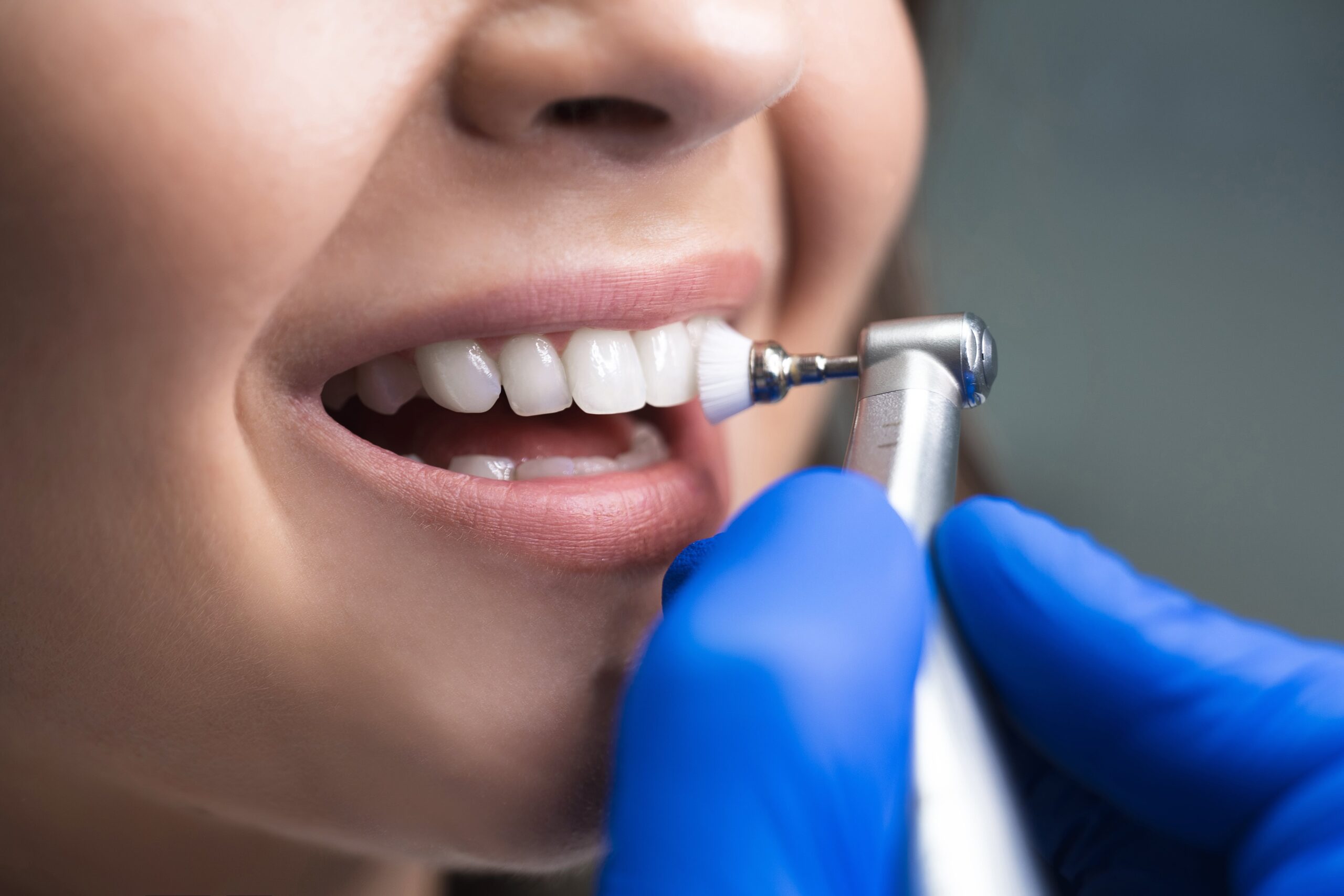 Why Regular Professional Teeth Cleaning Matters