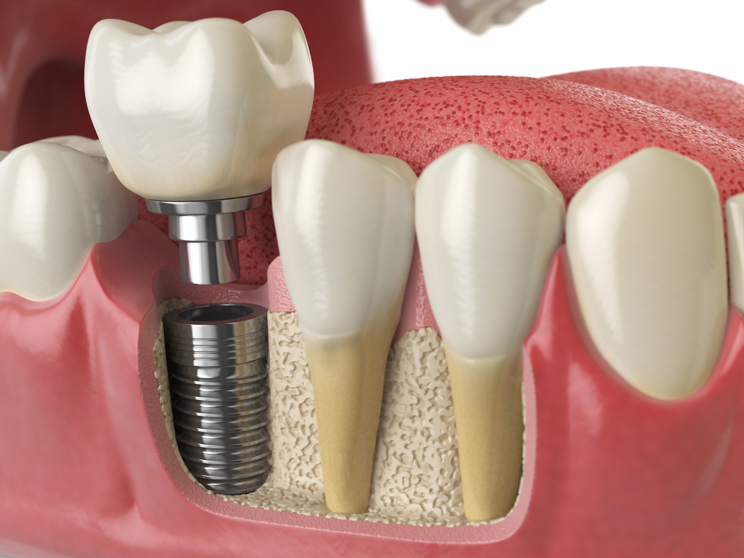 dental implants San Diego