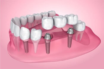 Dental Implants Downtown San Diego