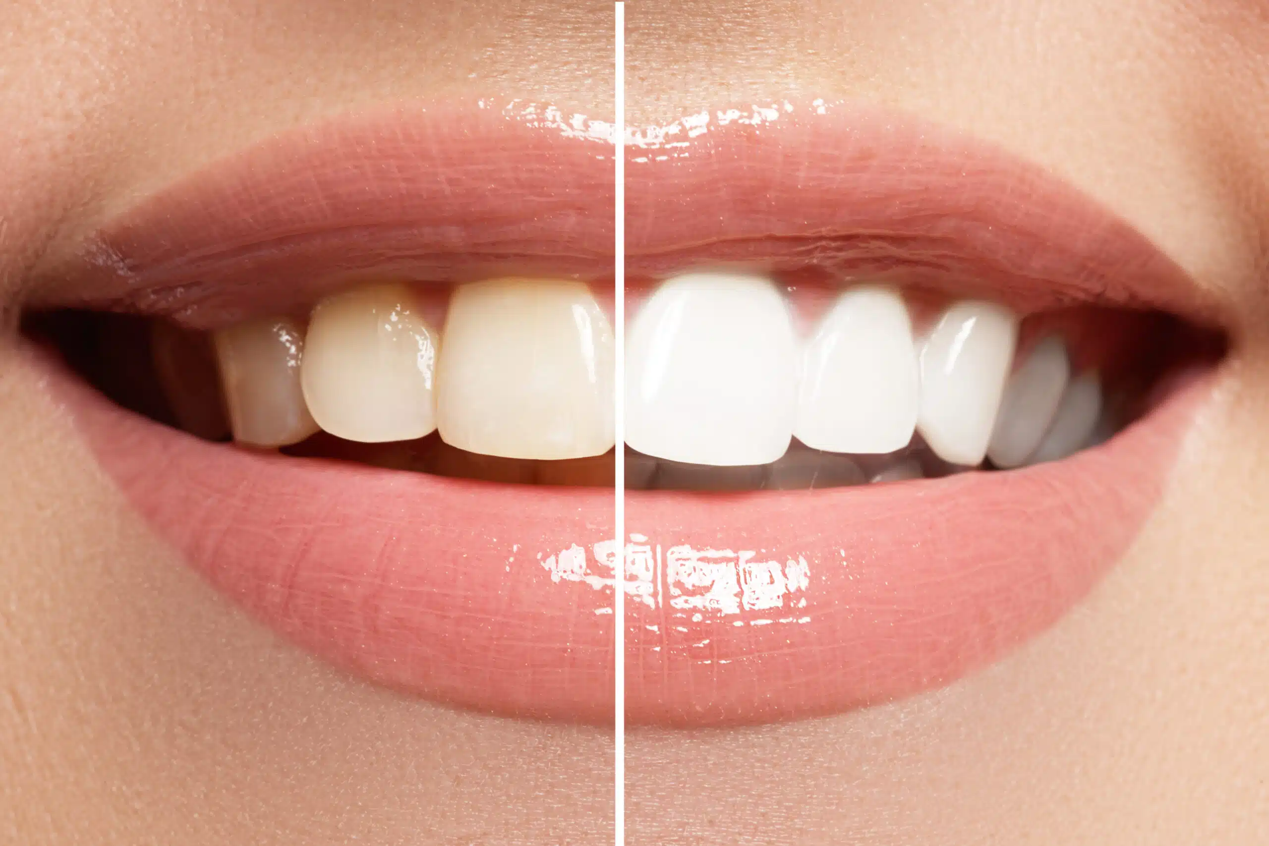 How To Prepare For A Teeth Whitening Treatment