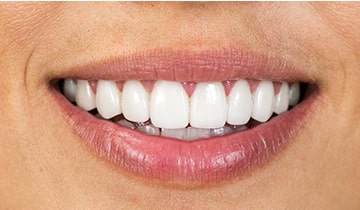 Veneers Gums Recontouring-Ortho After